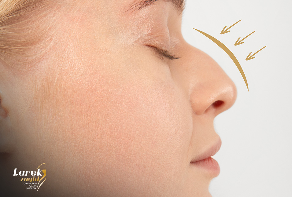 Causes-of-a-nasal-hump-and-how-it-can-be-Treated