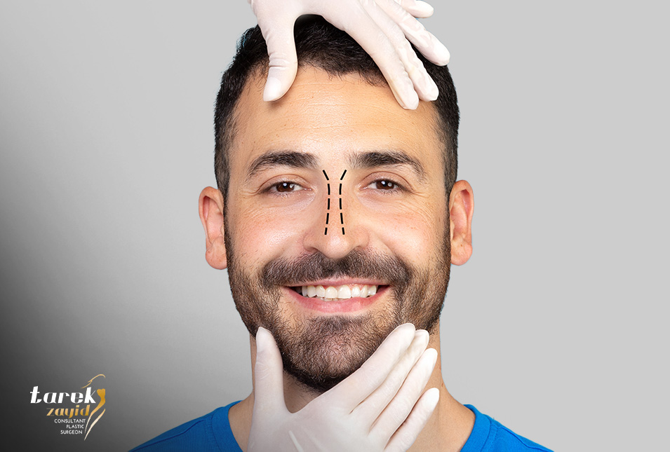 Male-Rhinoplasty-Before-and-After