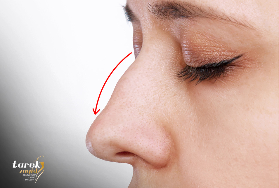 Surgery-for-a-Prominent-Nasal-Hump