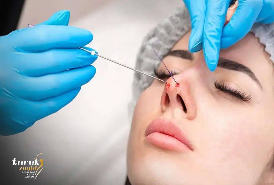 Thread-Rhinoplasty