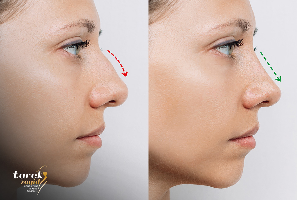 مراحل-تغير-الأنف-بعد-عملية-التجميل