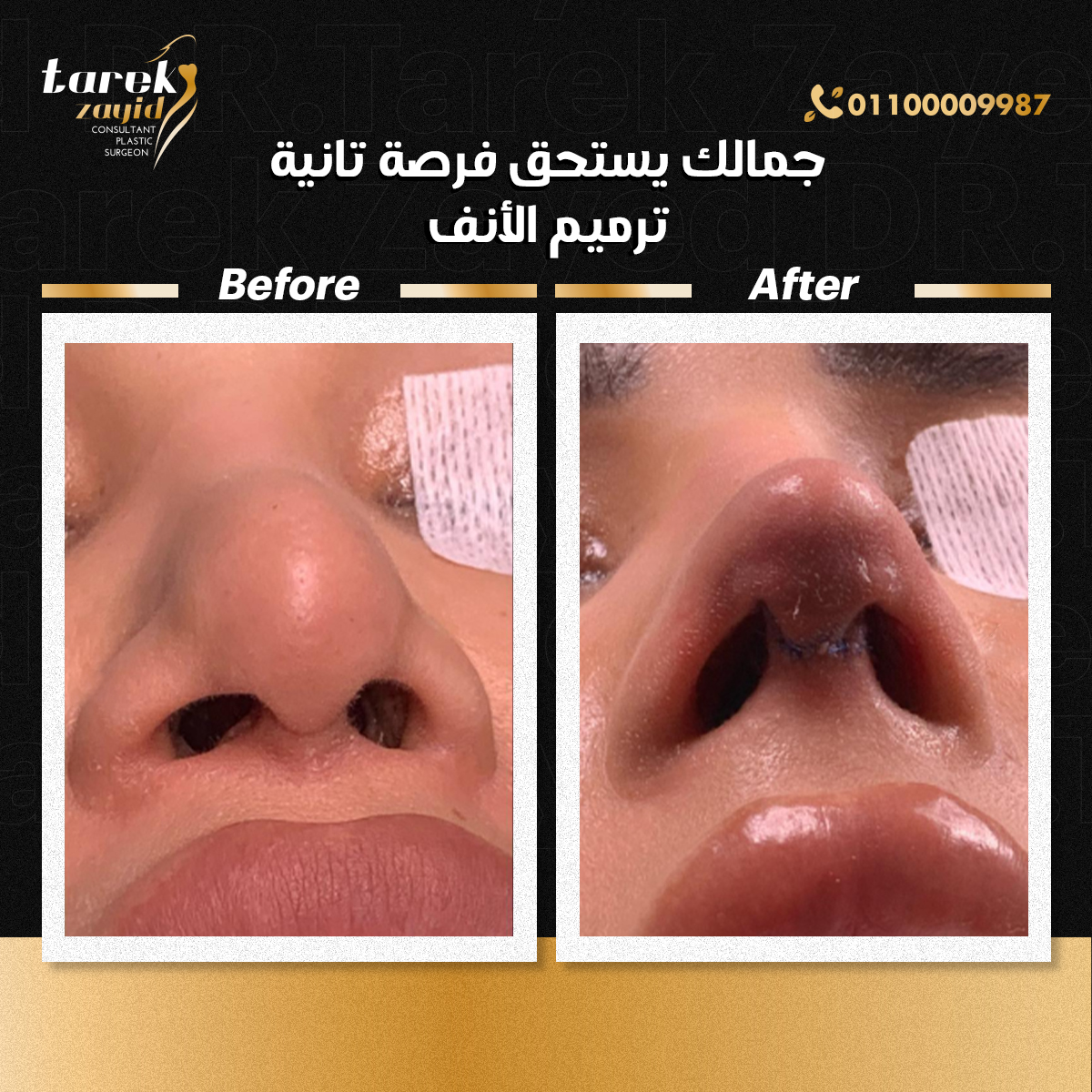 افضل دكتور تجميل انف في مصر