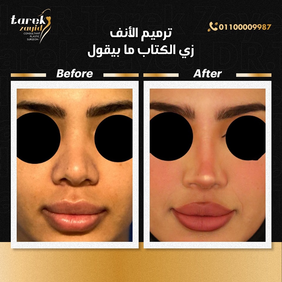 افضل دكتور تجميل انف في مصر