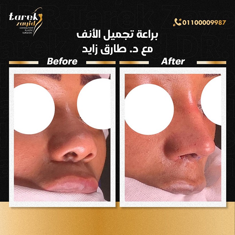 افضل دكتور تجميل انف في مصر